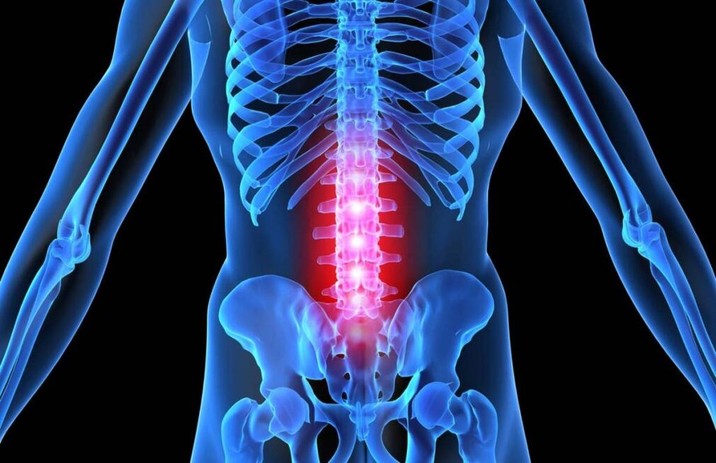 Osteochondroza kręgosłupa lędźwiowego
