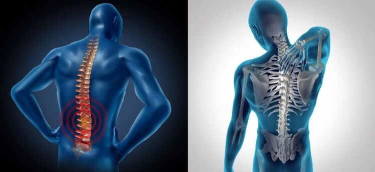 Zapalenie w osteochondrozie kręgosłupa