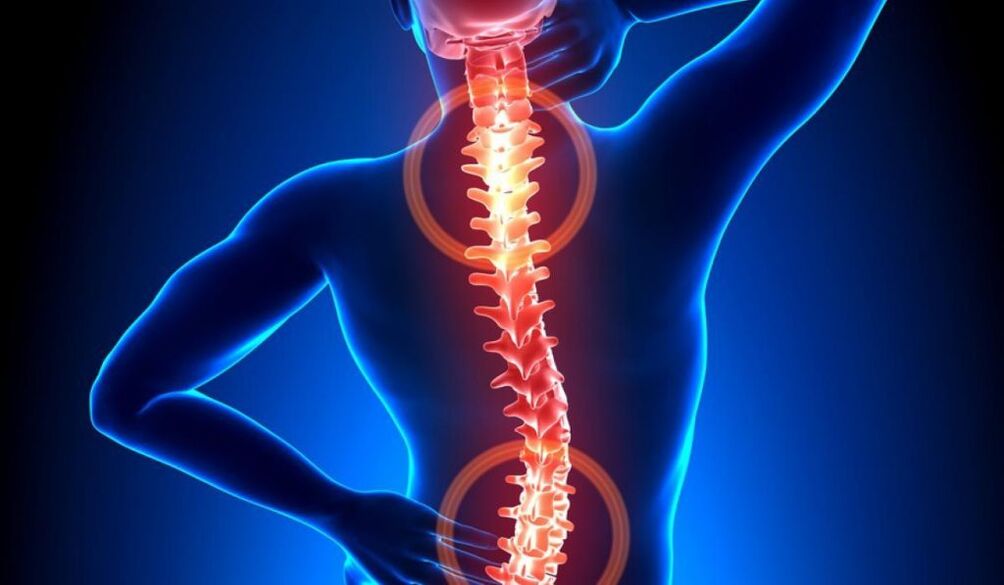 osteochondroza kręgosłupa