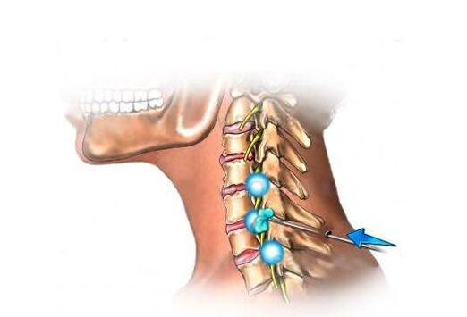 leczenie osteochondrozy szyjnej